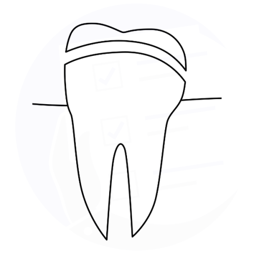 Intarsio dentale (overlay)